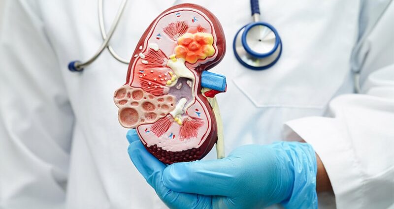 Dapagliflozin Safe and Effective in CKD Stages 4 and 5