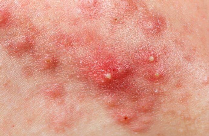Expert Discusses the ‘Four Pillars of Acne Pathogenesis’