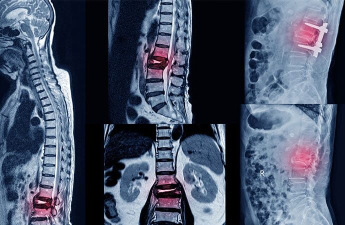 Iron Overload: The Silent Bone Breaker