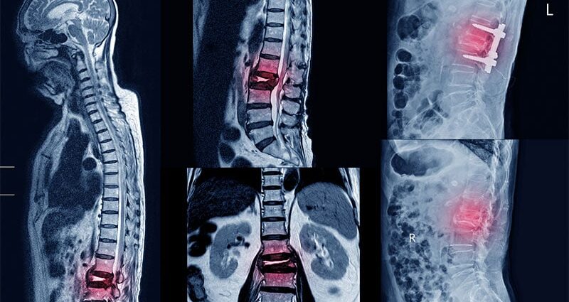 Iron Overload: The Silent Bone Breaker