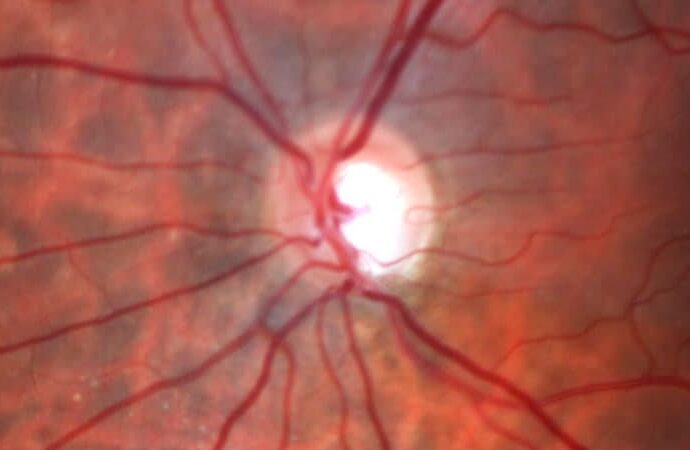 Study Finds Association Between Statins and Glaucoma