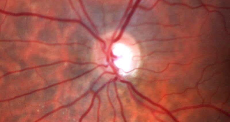 Study Finds Association Between Statins and Glaucoma