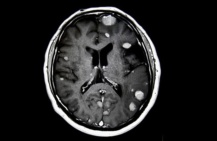 Preoperative Radiosurgery for Brain Metastases Shows Promise