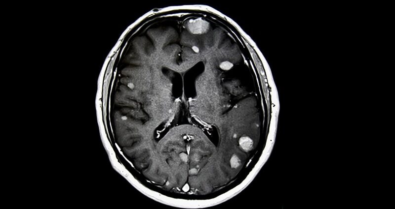 Preoperative Radiosurgery for Brain Metastases Shows Promise