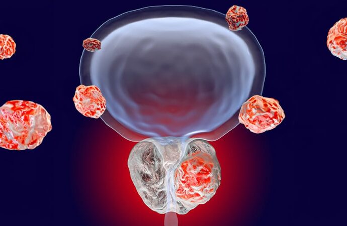 PSMA-PET Challenges Current Prostate Cancer Staging