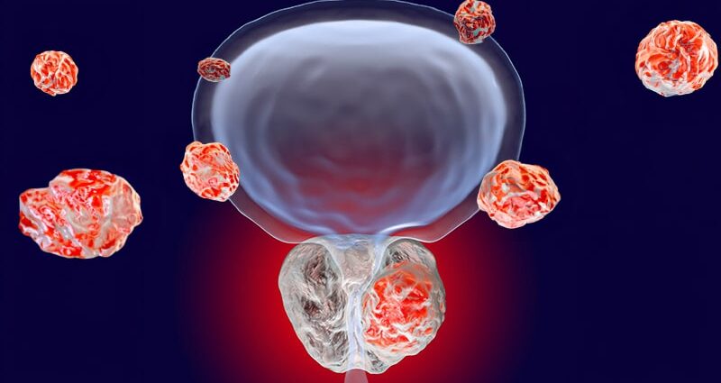 PSMA-PET Challenges Current Prostate Cancer Staging