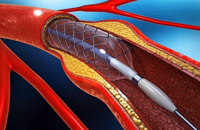 AHA Advisory Endorses EVT for Large Core Stroke