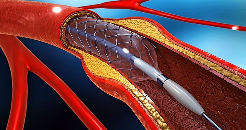 AHA Advisory Endorses EVT for Large Core Stroke