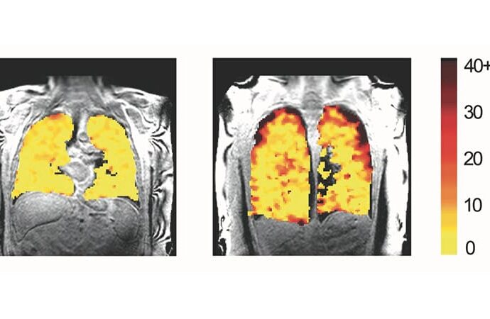 Lung MRI Using Inhaled Can Detect Damage