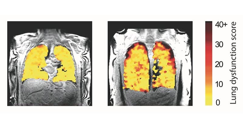 Lung MRI Using Inhaled Can Detect Damage