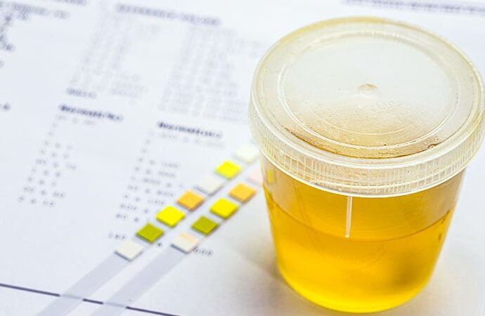 Urine-based Test Shows Promise in Detecting Bladder Cancer