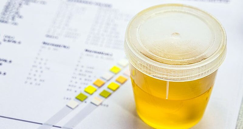 Urine-based Test Shows Promise in Detecting Bladder Cancer