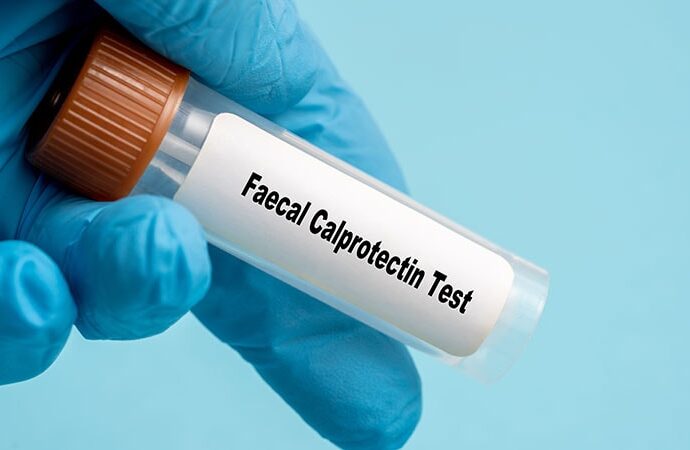 Fecal Calprotectin Predicts Disease Extent, Healing in UC