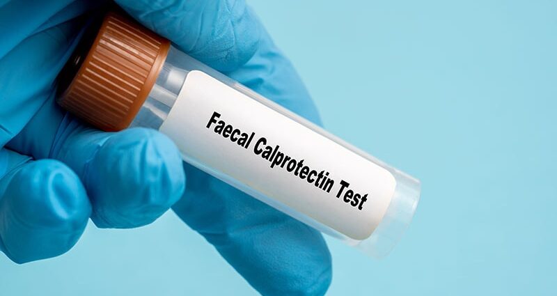 Fecal Calprotectin Predicts Disease Extent, Healing in UC