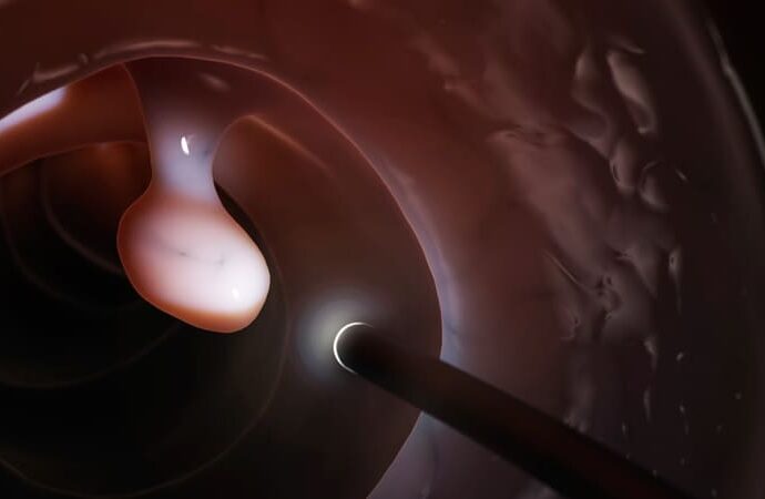 Cold EMR Safer for Colorectal Polyp Removal