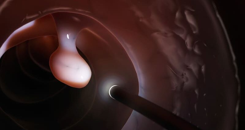 Cold EMR Safer for Colorectal Polyp Removal