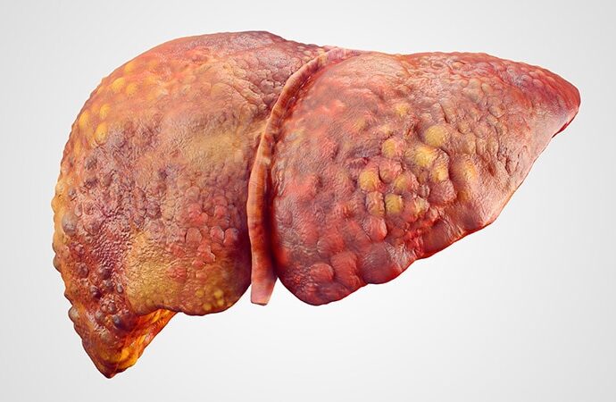 Nutrition Therapy Useful for Alcohol-Related ACLF