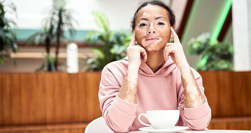 Vitiligo Study Identifies Three Patient Burden Profiles