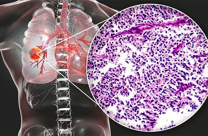 Immune Side Effects Tied to Better SCLC Survival