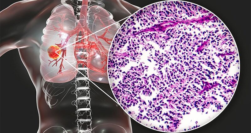 Immune Side Effects Tied to Better SCLC Survival