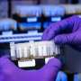 People with lupus who have certain antibodies are more likely to experience blood clots, researchers find