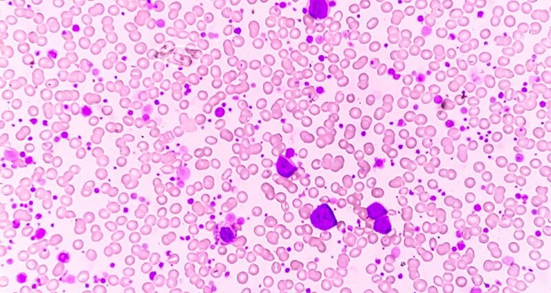 Ph-Positive Leukemia: No Longer a Death Sentence?