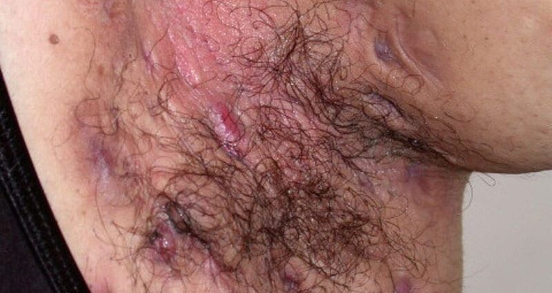 Secukinumab Cuts Chronic Pain in Hidradenitis Suppurativa