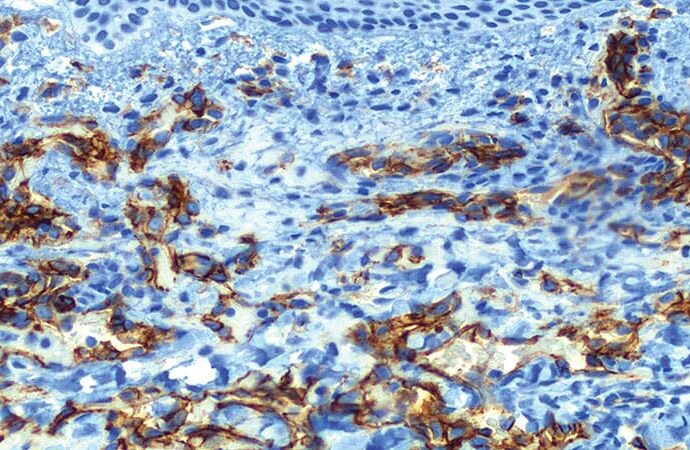 DIF Microscopy Helps Diagnose Pediatric Skin Diseases