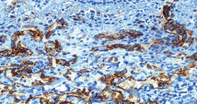DIF Microscopy Helps Diagnose Pediatric Skin Diseases