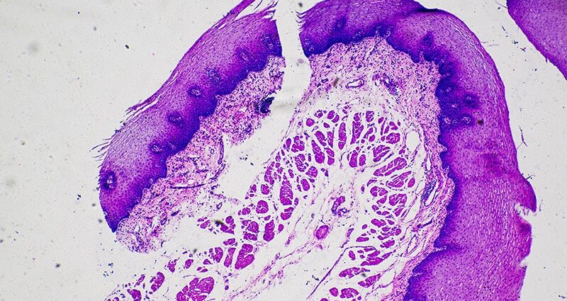 AI-Derived Risk Score May Improve Risk Stratification of Squamous Cell Carcinomas