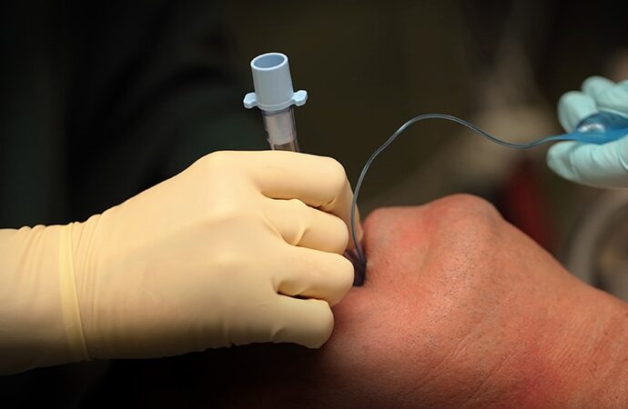 Rapid Sequence Intubation Boosts First-Pass Success