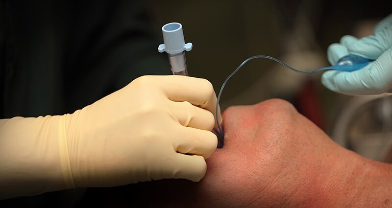 Rapid Sequence Intubation Boosts First-Pass Success