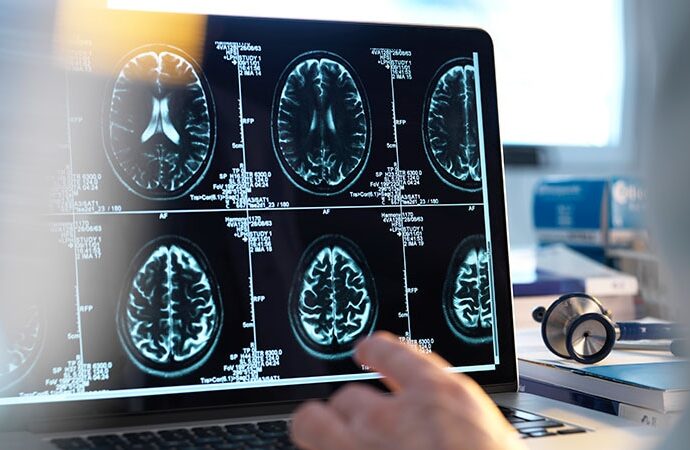 Predictors and Therapies in Primary CNS Angiitis Outcomes