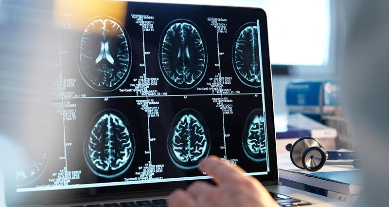 Predictors and Therapies in Primary CNS Angiitis Outcomes