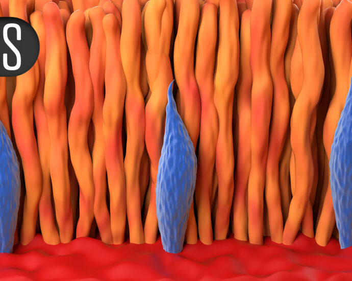 Combination Therapy for AMD Fails to Improve Vision Versus Single Drug