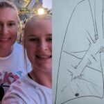 Broken limb leads to non-smoker’s lung cancer diagnosis years later