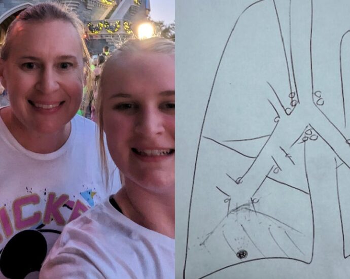 Broken limb leads to non-smoker’s lung cancer diagnosis years later