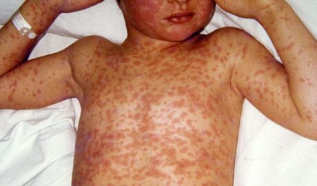 What Doctors in Measles Outbreak Zones Want You to Know