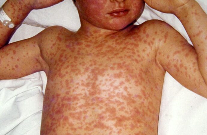What Doctors in Measles Outbreak Zones Want You to Know