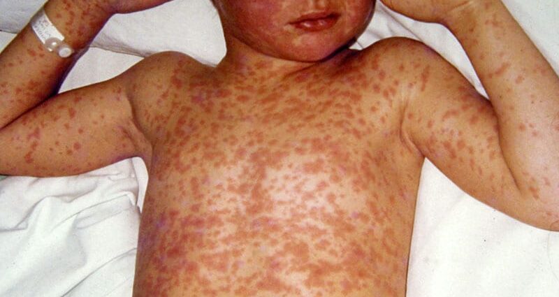 What Doctors in Measles Outbreak Zones Want You to Know