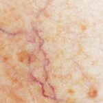 Investigational Oral Drug Shows Promise in Genetic Bleeding Disorder