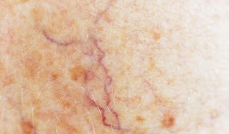 Investigational Oral Drug Shows Promise in Genetic Bleeding Disorder