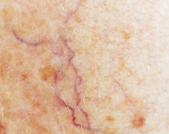 Investigational Oral Drug Shows Promise in Genetic Bleeding Disorder