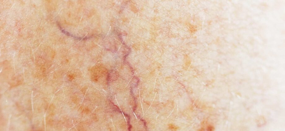 Investigational Oral Drug Shows Promise in Genetic Bleeding Disorder