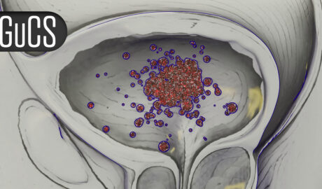 ‘Very Impressive’ Survival With Combo in First-Line Prostate Cancer Study