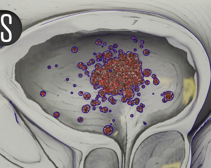 ‘Very Impressive’ Survival With Combo in First-Line Prostate Cancer Study