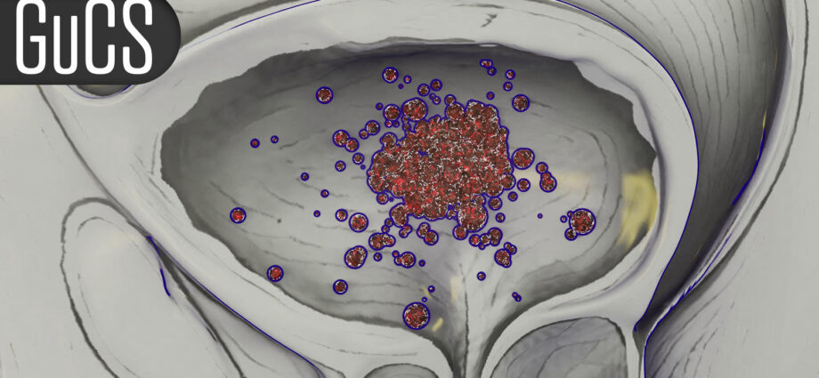 ‘Very Impressive’ Survival With Combo in First-Line Prostate Cancer Study