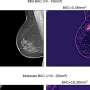 AI can predict risk of serious heart disease from mammograms