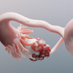 Novel Regimen Boosts Survival for Recurrent Platinum-Resistant Ovarian Cancer