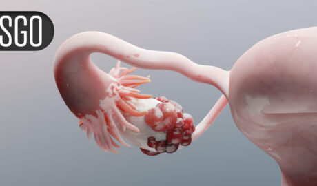 Novel Regimen Boosts Survival for Recurrent Platinum-Resistant Ovarian Cancer